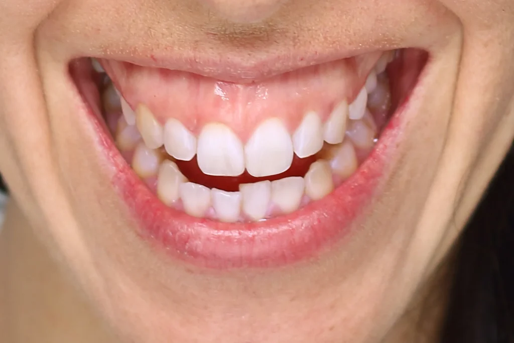 gum recession los angeles ca​