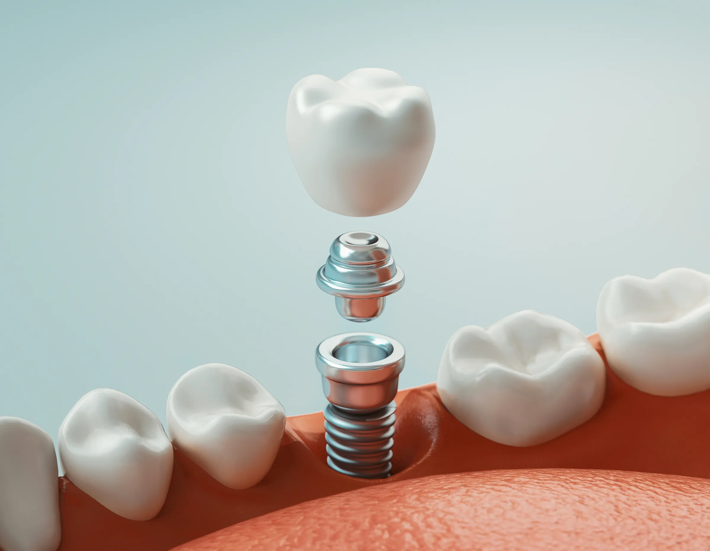 los angeles dental implants​