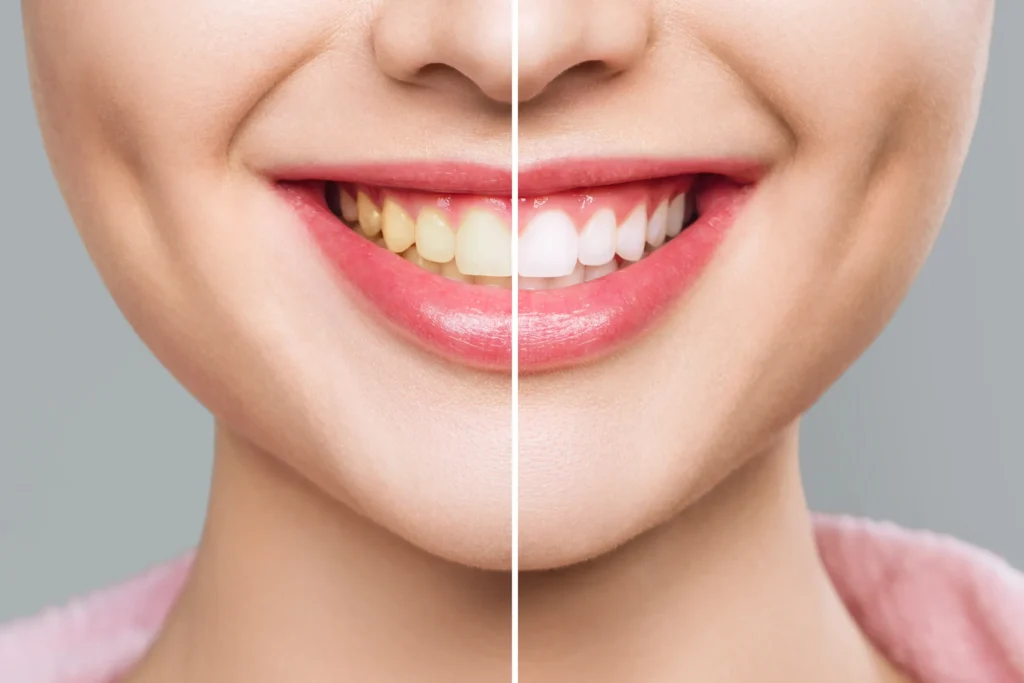 teeth whitening los angeles​