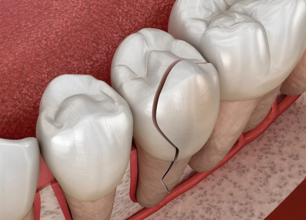 Emergency Veneers in Los Angeles, CA