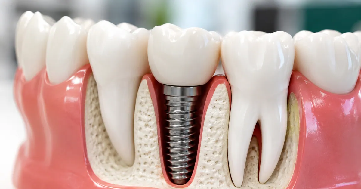 How Long Do Dental Implants Last?